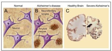 Amyloid Plaques
